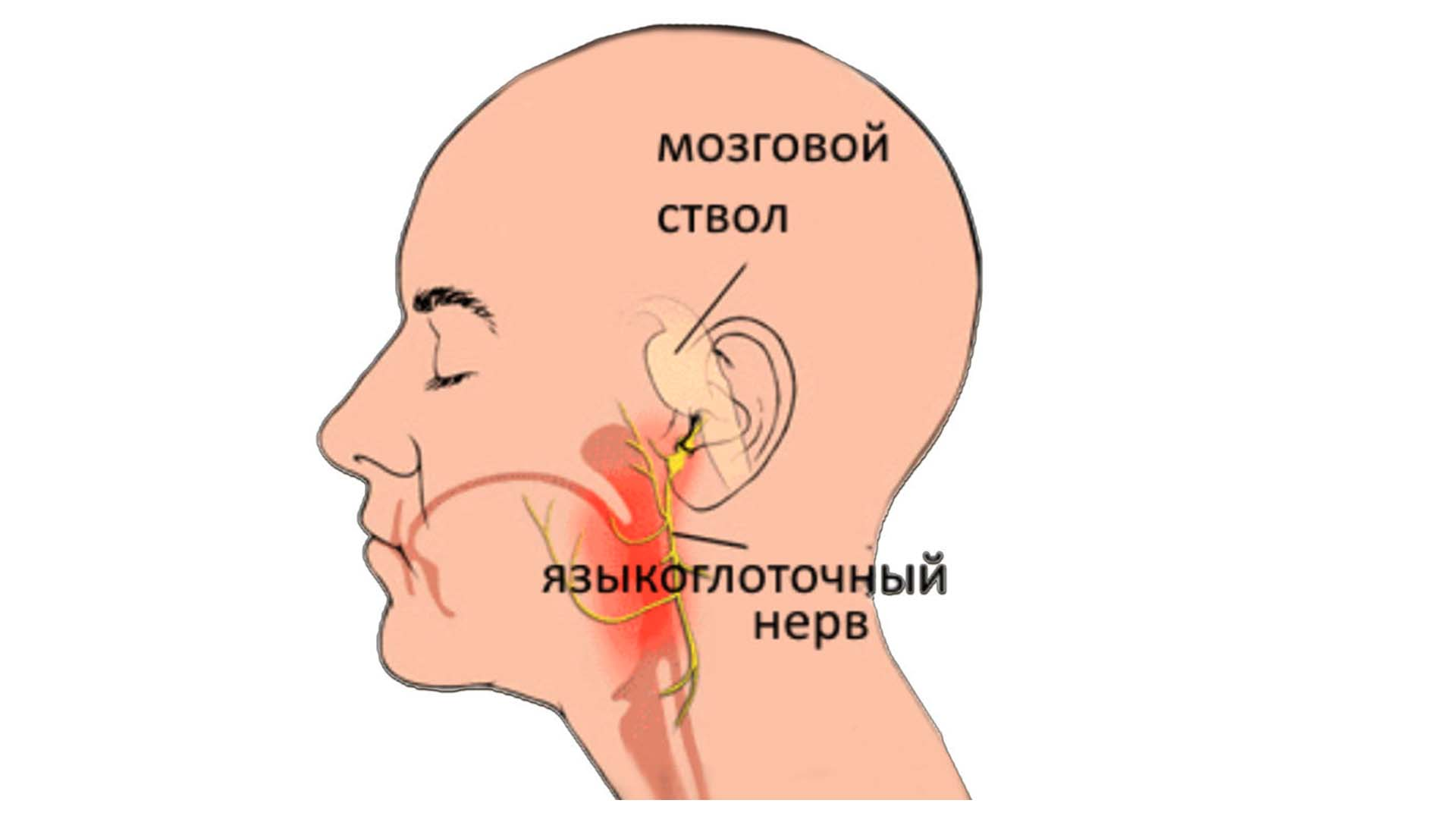 Мозговой ствол и языкоглоточный нерв